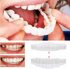 Smile Veneer (Superior e Inferior Inclusos)