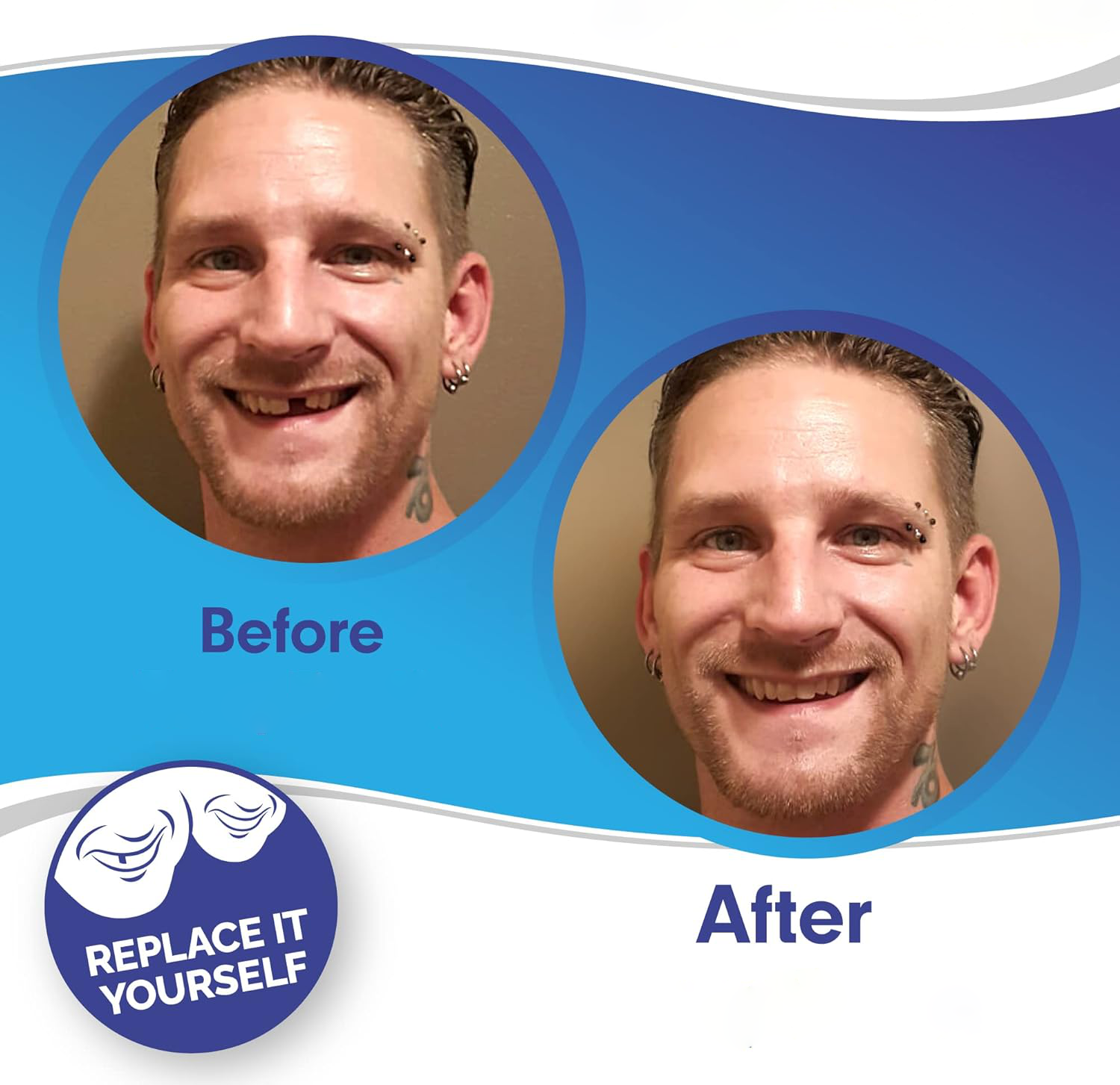 Smile Veneer (Superior e Inferior Inclusos)