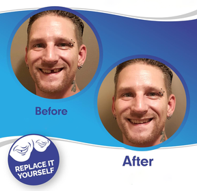 Smile Veneer (Superior e Inferior Inclusos)