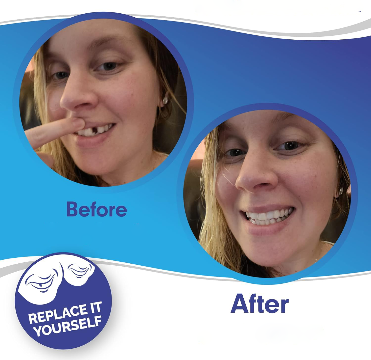 Smile Veneer (Superior e Inferior Inclusos)