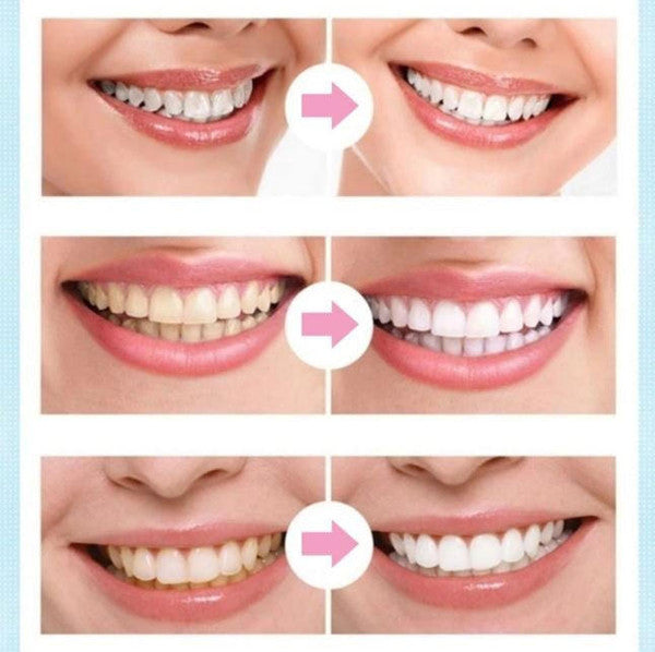 Caneta Clareadora Dental