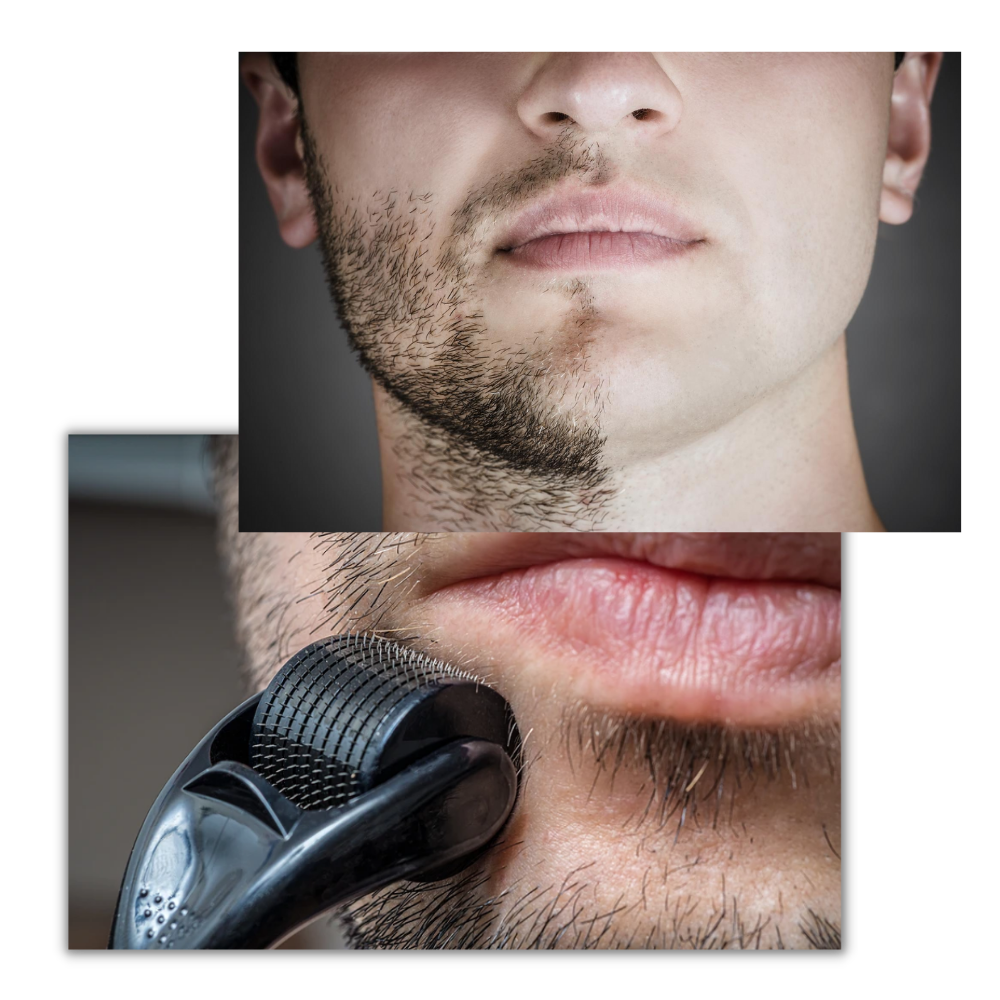 Dermal Roller Para Crescimento De Cabelo E Barba