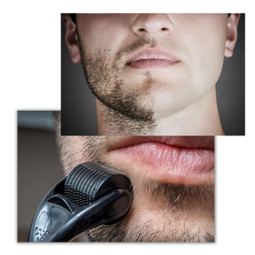 Dermal Roller Para Crescimento De Cabelo E Barba