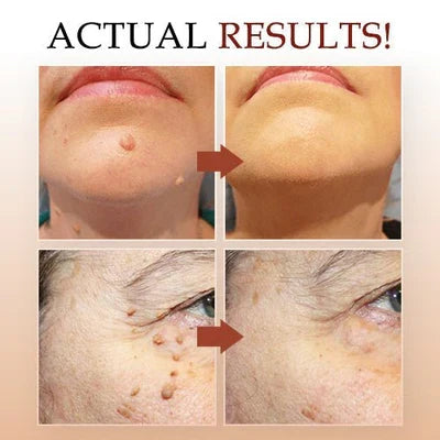 Tags & Moles Remover