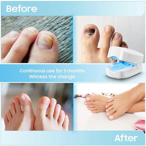 Dispositivo a Laser para Limpeza de Fungos nas Unhas - Dispositivo de Fototerapia Especialista, Revolucionário e de Alta Eficiência para Doenças nas Unhas dos Pés