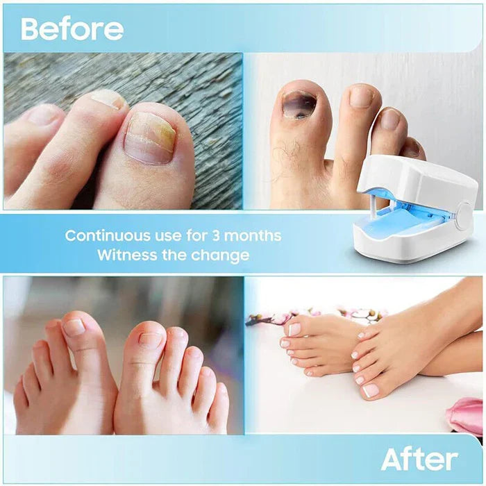 Dispositivo a Laser para Limpeza de Fungos nas Unhas - Dispositivo de Fototerapia Especialista, Revolucionário e de Alta Eficiência para Doenças nas Unhas dos Pés