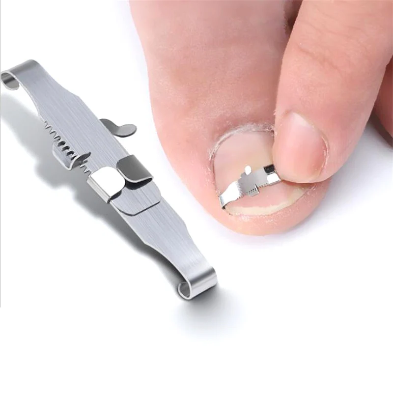 Ferramenta corretora de unha encravada Produto de saúde Ferramenta de correção de unhas Cuidados com os pés