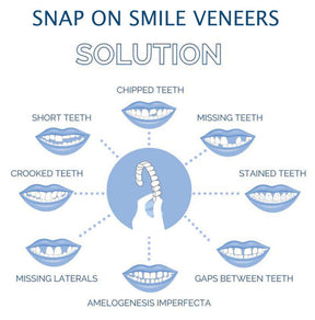 Smile Veneer (Superior e Inferior Inclusos)