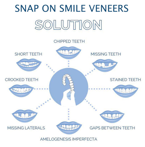 Smile Veneer (Superior e Inferior Inclusos)