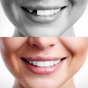 Dentes Falsos Moldáveis Originais