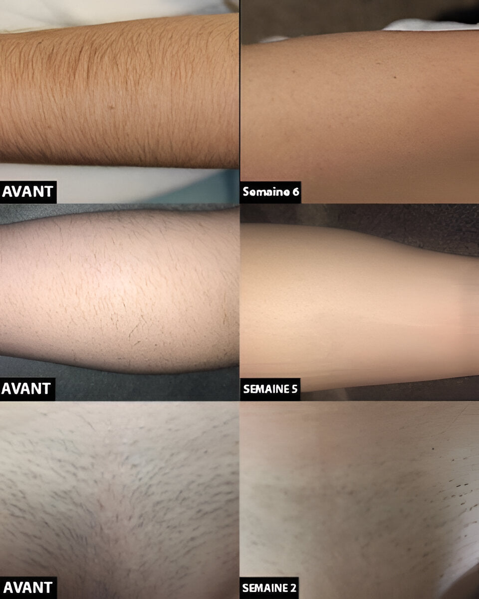 Depilação a laser definitiva